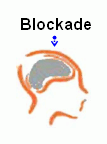 Blockaden sitzen im Gehirn